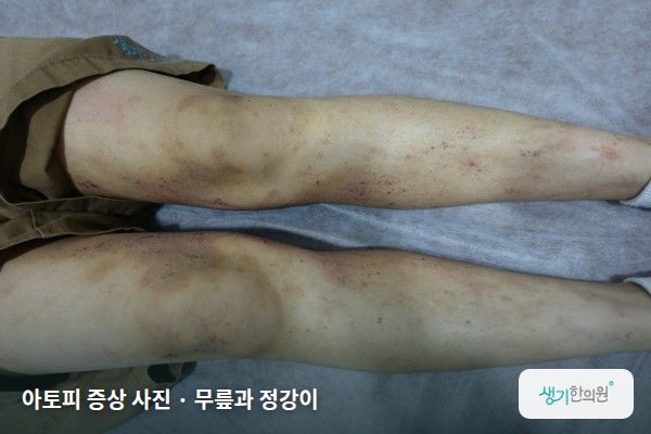 무릎과 정강이에 생긴 아토피 증상 사진 — 아토피 증상 사진 · 무릎과 정강이