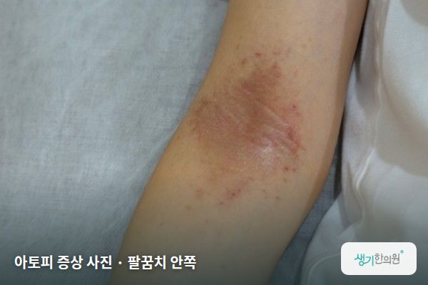 팔꿈치 안쪽에 생긴 아토피 증상 사진 — 아토피 증상 사진 · 팔꿈치 안쪽
