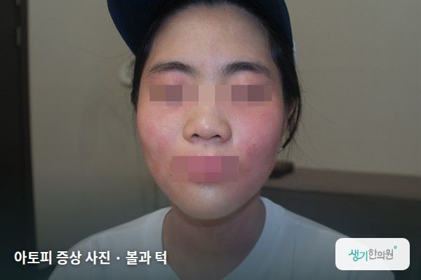 볼과 턱에 생긴 아토피 증상 사진 — 아토피 증상 사진 · 볼과 턱