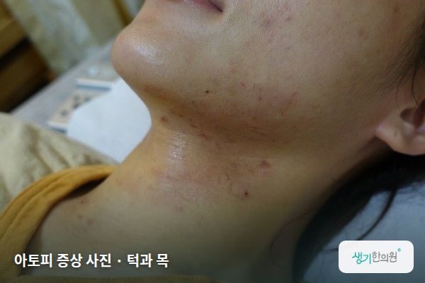 턱과 목에 생긴 아토피 증상 사진 — 아토피 증상 사진 · 턱과 목