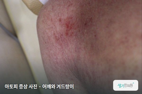 어깨와 겨드랑이에 생긴 아토피 증상 사진 — 아토피 증상 사진 · 어깨와 겨드랑이