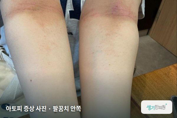 팔꿈치 안쪽에 생긴 아토피 증상 사진 — 아토피 증상 사진 · 팔꿈치 안쪽