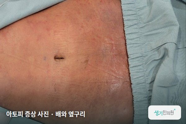 배와 옆구리에 생긴 아토피 증상 사진 — 아토피 증상 사진 · 배와 옆구리