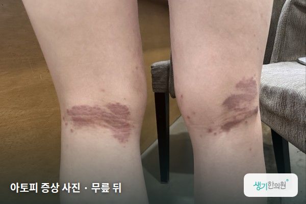 무릎 뒤에 생긴 아토피 증상 사진 — 아토피 증상 사진 · 무릎 뒤