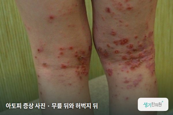 무릎 뒤와 허벅지 뒤에 생긴 아토피 증상 사진 — 아토피 증상 사진 · 무릎 뒤와 허벅지 뒤