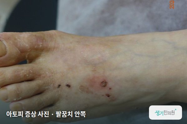 팔꿈치 안쪽에 생긴 아토피 증상 사진 — 아토피 증상 사진 · 팔꿈치 안쪽