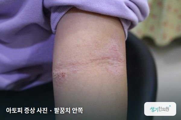 팔꿈치 안쪽에 생긴 아토피 증상 사진 — 아토피 증상 사진 · 팔꿈치 안쪽