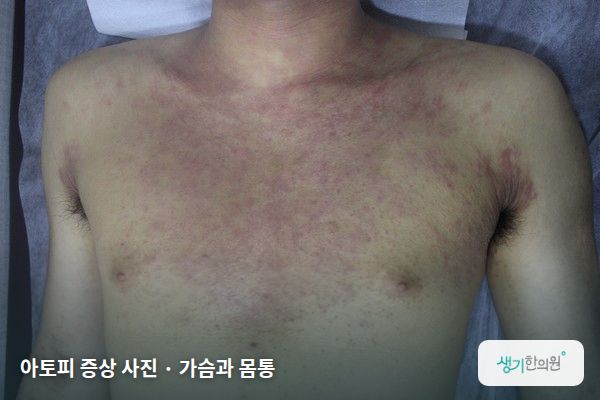 가슴과 몸통에 생긴 아토피 증상 사진 — 아토피 증상 사진 · 가슴과 몸통