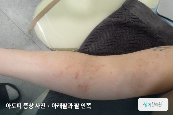 아래팔과 팔 안쪽에 생긴 아토피 증상 사진 — 아토피 증상 사진 · 아래팔과 팔 안쪽