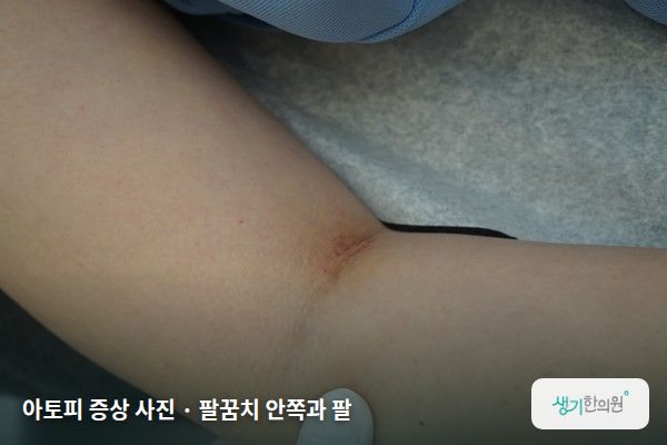 팔꿈치 안쪽과 팔에 생긴 아토피 증상 사진 — 아토피 증상 사진 · 팔꿈치 안쪽과 팔