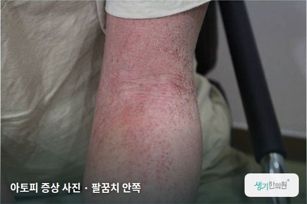 팔꿈치 안쪽에 생긴 아토피 증상 사진 — 아토피 증상 사진 · 팔꿈치 안쪽