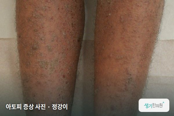 정강이에 생긴 아토피 증상 사진 — 아토피 증상 사진 · 정강이
