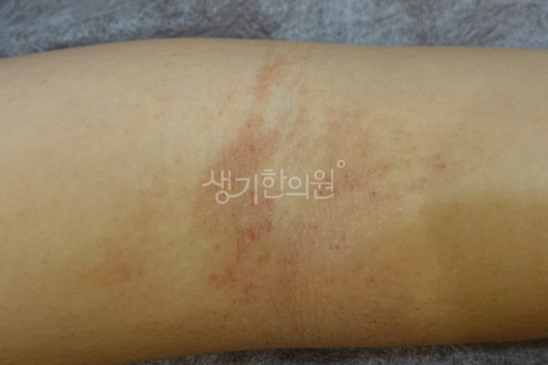 팔 안쪽의 아토피 증상 사진