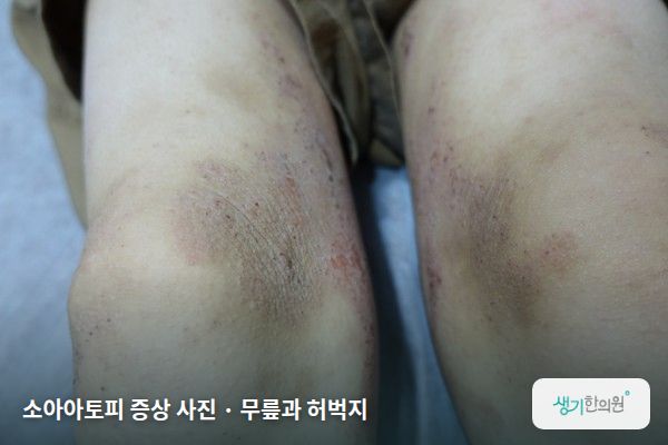 무릎과 허벅지에 생긴 소아아토피 증상 사진 — 소아아토피 증상 사진 · 무릎과 허벅지
