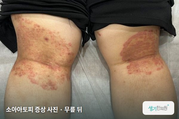 무릎 뒤에 생긴 소아아토피 증상 사진 — 소아아토피 증상 사진 · 무릎 뒤