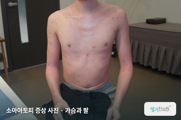 가슴과 팔에 생긴 소아아토피 증상 사진 — 소아아토피 증상 사진 · 가슴과 팔