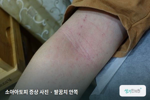 팔꿈치 안쪽에 생긴 소아아토피 증상 사진 — 소아아토피 증상 사진 · 팔꿈치 안쪽