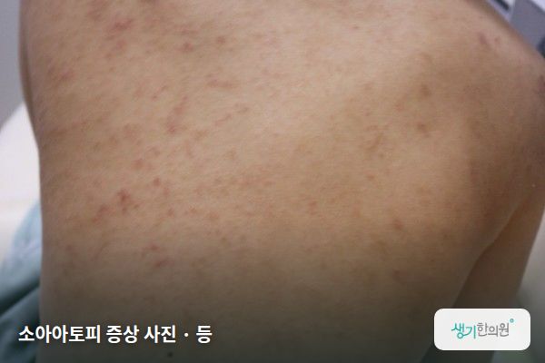 등에 생긴 소아아토피 증상 사진 — 소아아토피 증상 사진 · 등
