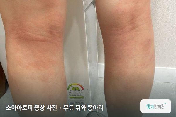 무릎 뒤와 종아리에 생긴 소아아토피 증상 사진 — 소아아토피 증상 사진 · 무릎 뒤와 종아리