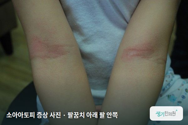 팔꿈치 아래 팔 안쪽에 생긴 소아아토피 증상 사진 — 소아아토피 증상 사진 · 팔꿈치 아래 팔 안쪽