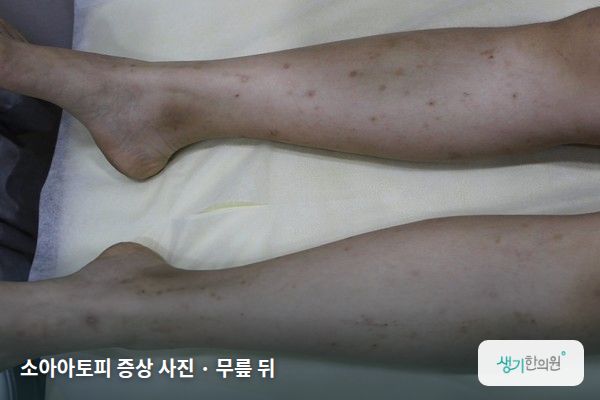 무릎 뒤에 생긴 소아아토피 증상 사진 — 소아아토피 증상 사진 · 무릎 뒤