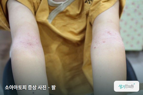 팔에 생긴 소아아토피 증상 사진 — 소아아토피 증상 사진 · 팔