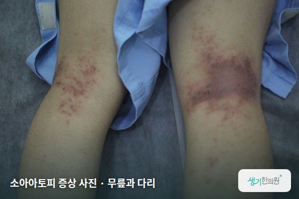무릎과 다리에 생긴 소아아토피 증상 사진 — 소아아토피 증상 사진 · 무릎과 다리