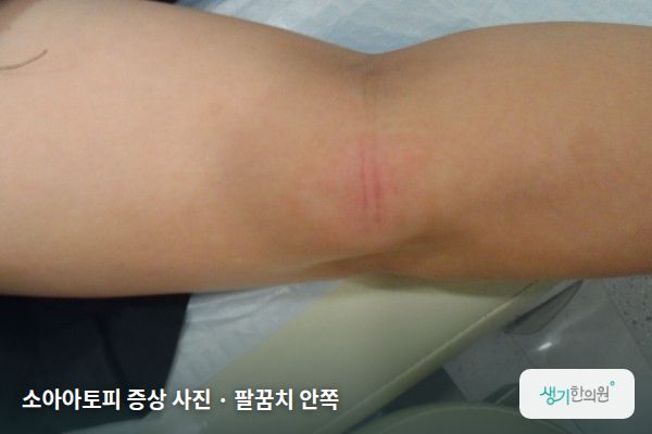 팔꿈치 안쪽에 생긴 소아아토피 증상 사진 — 소아아토피 증상 사진 · 팔꿈치 안쪽