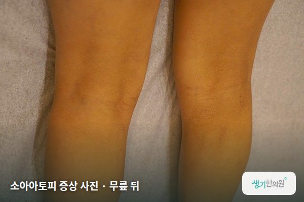 무릎 뒤에 생긴 소아아토피 증상 사진 — 소아아토피 증상 사진 · 무릎 뒤