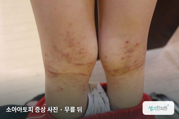 무릎 뒤에 생긴 소아아토피 증상 사진