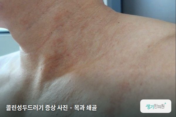 목과 쇄골에 생긴 콜린성두드러기 증상 사진 — 콜린성두드러기 증상 사진 · 목과 쇄골