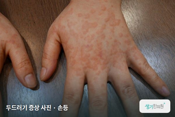 손등에 생긴 콜린성두드러기 증상 사진 — 두드러기 증상 사진 · 손등