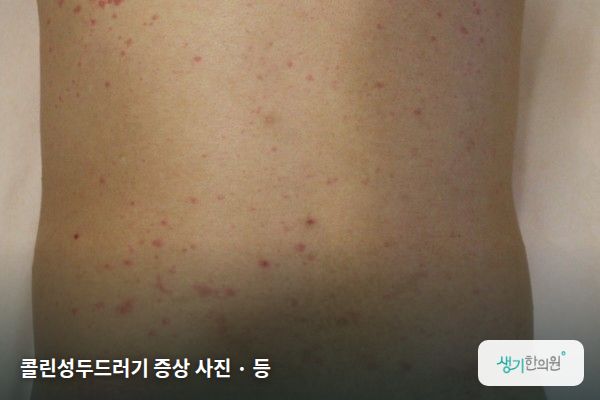 등에 생긴 콜린성두드러기 증상 사진 — 콜린성두드러기 증상 사진 · 등