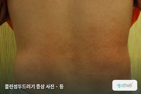 등에 생긴 콜린성두드러기 증상 사진 — 콜린성두드러기 증상 사진 · 등