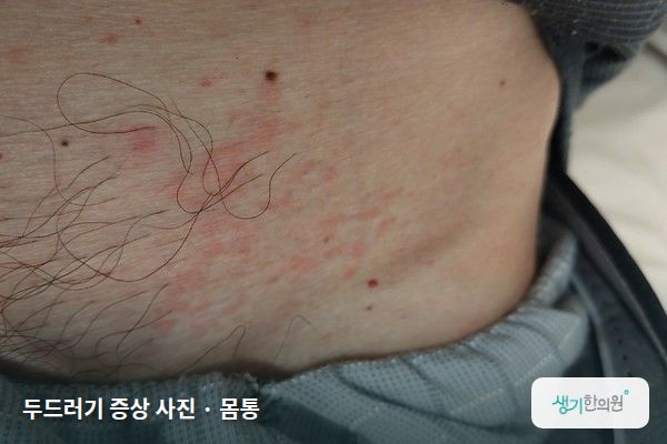 몸통에 생긴 콜린성두드러기 증상 사진 — 두드러기 증상 사진 · 몸통