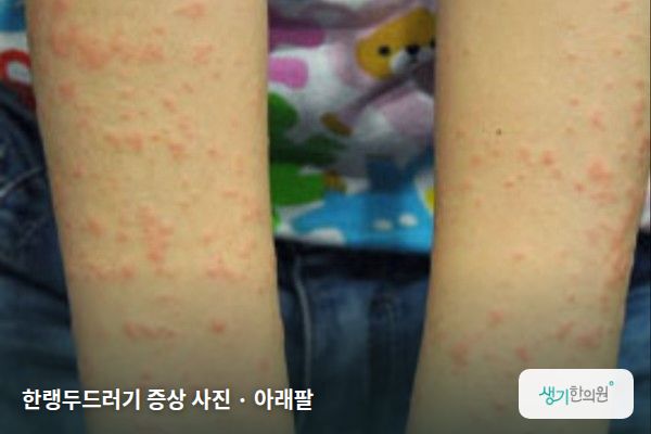 아래팔에 생긴 한랭두드러기 증상 사진 — 한랭두드러기 증상 사진 · 아래팔