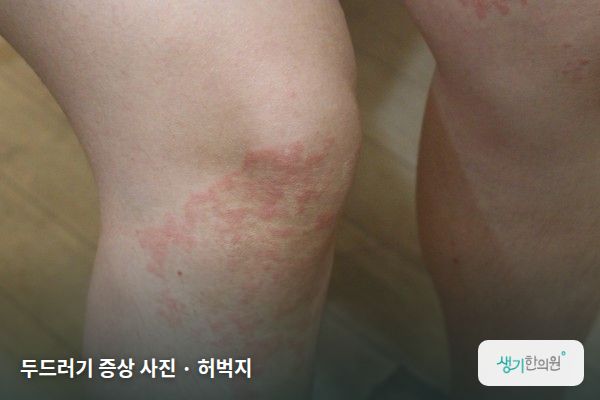 허벅지에 생긴 한랭두드러기 증상 사진 — 두드러기 증상 사진 · 허벅지
