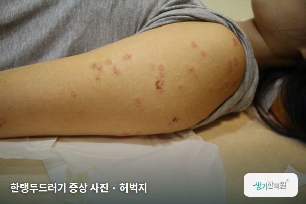 허벅지에 생긴 한랭두드러기 증상 사진 — 한랭두드러기 증상 사진 · 허벅지