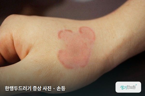 손등에 생긴 한랭두드러기 증상 사진 — 한랭두드러기 증상 사진 · 손등