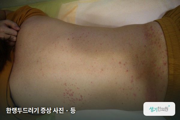 등에 생긴 한랭두드러기 증상 사진 — 한랭두드러기 증상 사진 · 등