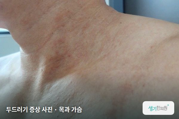 목과 가슴에 생긴 한랭두드러기 증상 사진 — 두드러기 증상 사진 · 목과 가슴