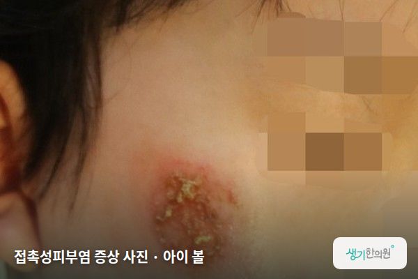 아이 볼에 생긴 접촉성피부염 증상 사진 — 접촉성피부염 증상 사진 · 아이 볼