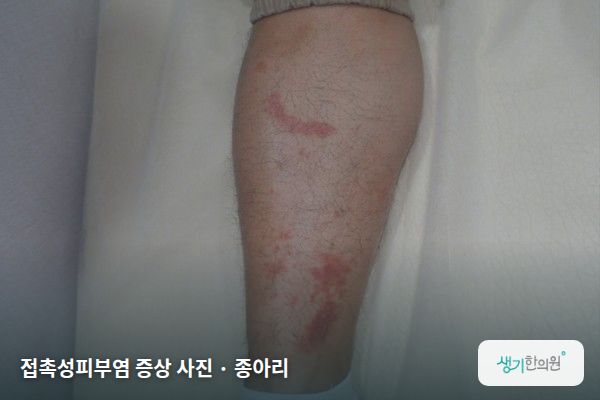 종아리에 생긴 접촉성피부염 증상 사진 — 접촉성피부염 증상 사진 · 종아리