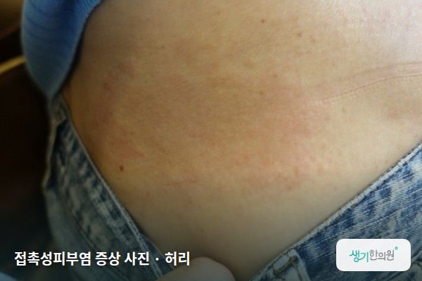 허리에 생긴 접촉성피부염 증상 사진 — 접촉성피부염 증상 사진 · 허리