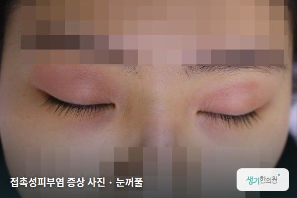 눈꺼풀에 생긴 접촉성피부염 증상 사진 — 접촉성피부염 증상 사진 · 눈꺼풀