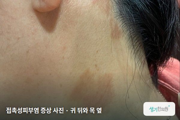 귀 뒤와 목 옆에 생긴 접촉성피부염 증상 사진 — 접촉성피부염 증상 사진 · 귀 뒤와 목 옆