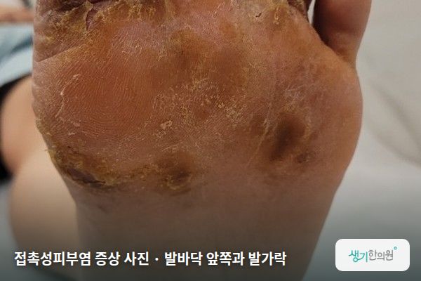 발바닥 앞쪽과 발가락에 생긴 접촉성피부염 증상 사진 — 접촉성피부염 증상 사진 · 발바닥 앞쪽과 발가락