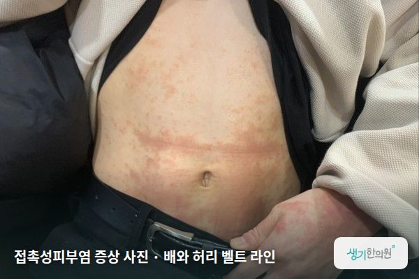 배와 허리 벨트 라인에 생긴 접촉성피부염 증상 사진 — 접촉성피부염 증상 사진 · 배와 허리 벨트 라인