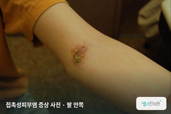 팔 안쪽에 생긴 접촉성피부염 증상 사진 — 접촉성피부염 증상 사진 · 팔 안쪽