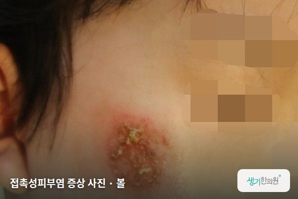 볼에 생긴 접촉성피부염 증상 사진 — 접촉성피부염 증상 사진 · 볼